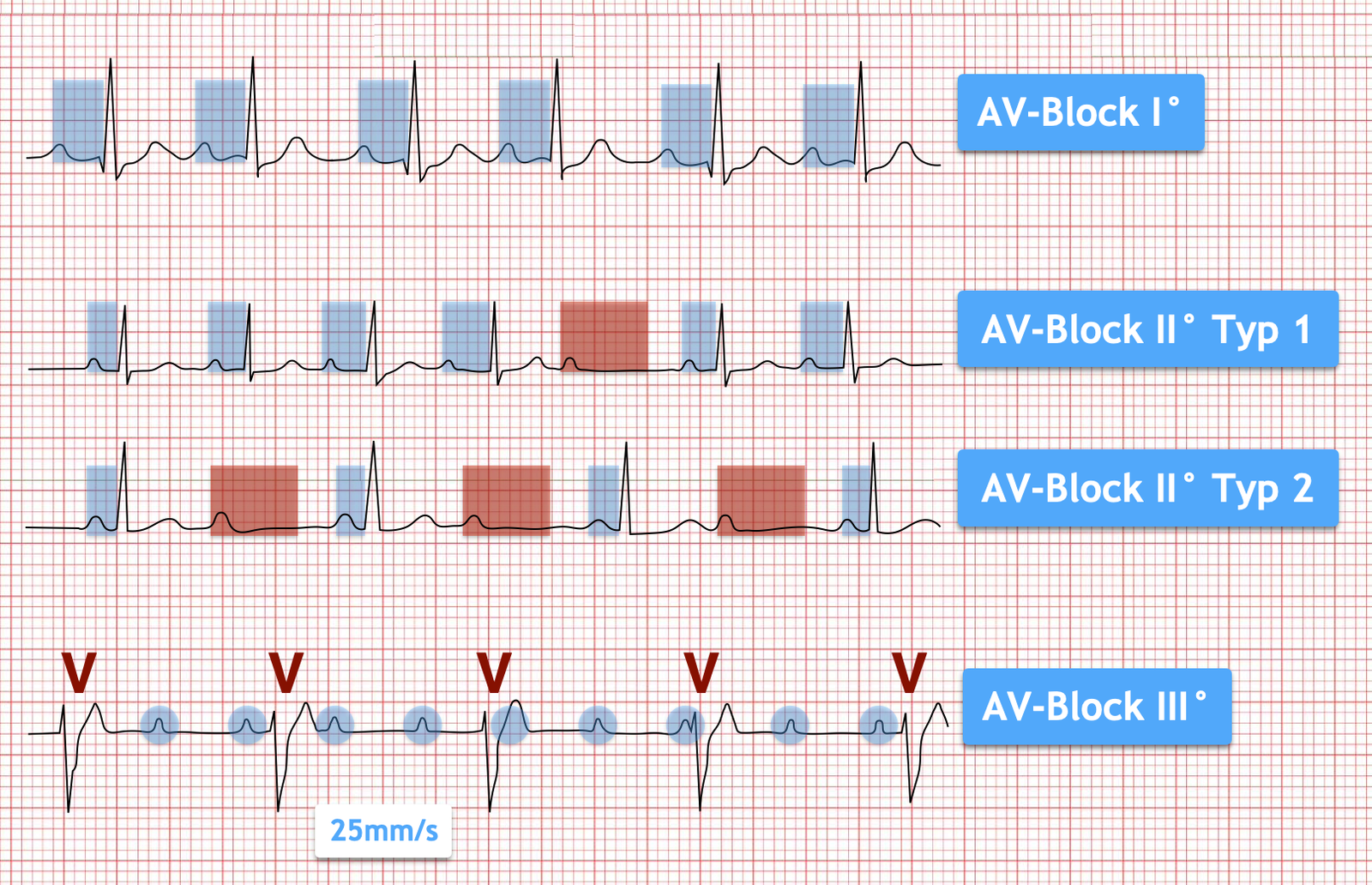 AVBlock
