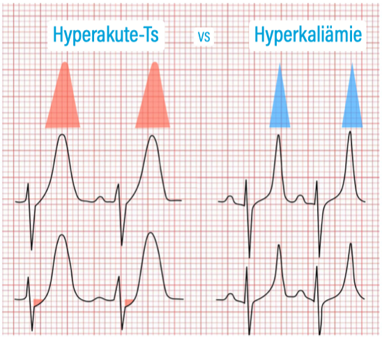 Hyperakut