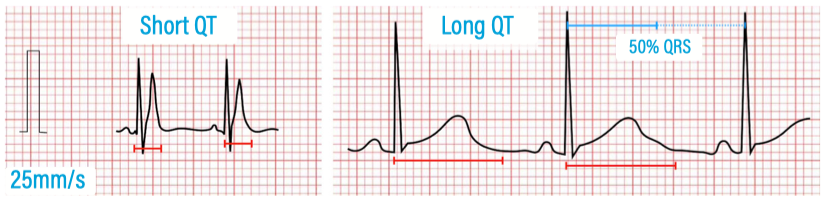 Qtc