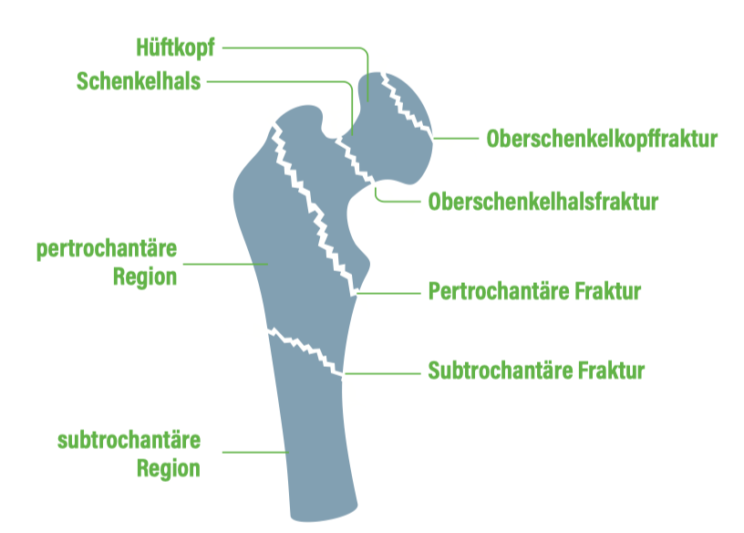 Schenkelhals